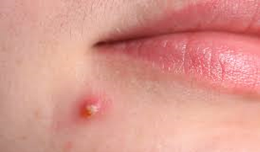 How to Remove Pimple Marks Naturally at Home - Cacherbal | Ayurvedic Treatment